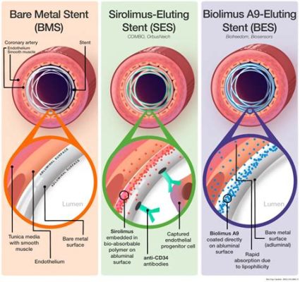 Imiglutid İlaçlı Stentler: Kalp Sağlığı İçin Devrim mi?